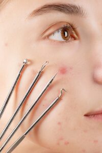 Close-up of skincare tools on acne-affected skin for dermatological treatment.